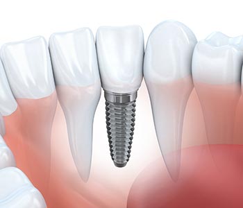The importance of replacing missing teeth Dental Implants Waterloo ON
