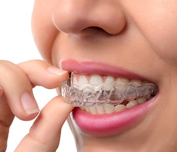 A woman wearing invisalign from Invisalign best provider near Waterloo ON