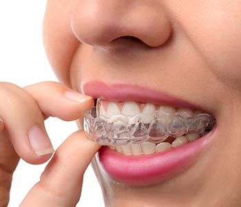 Invisalign Waterloo ON - Teeth Straightening - Invisible Braces