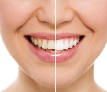 Teeth whitening before and after image Waterloo ON