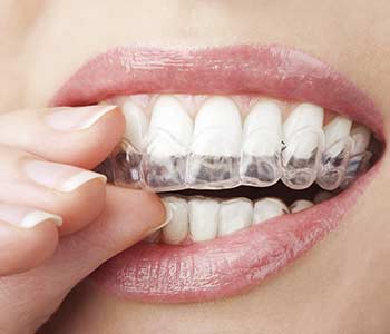 What is Invisalign in Waterloo, ON area