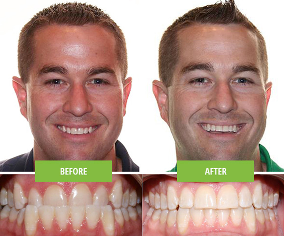 Invisalign male patient before and after extra oral.