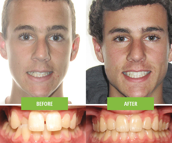 Invisalign Teen male patient before and after extra oral.