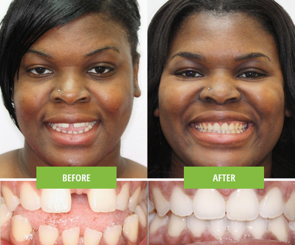 Invisalign female patient before and after extra oral.