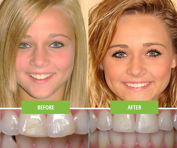 Invisalign Teen female patient before and after extra oral.