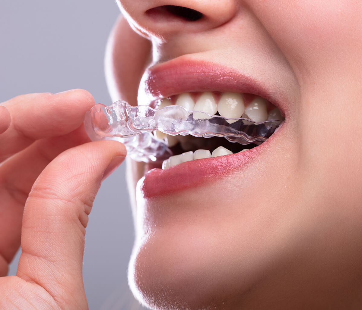 Invisalign Teeth Straightening Waterloo - Benefits of Invisalign