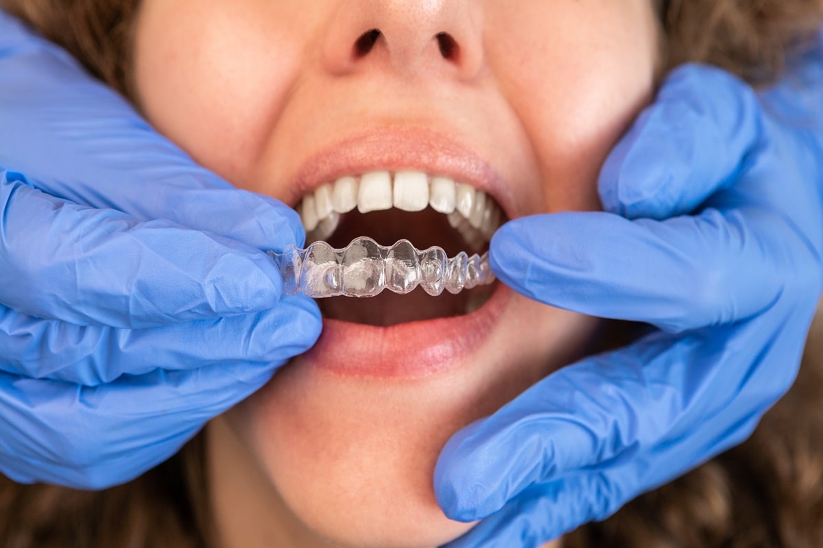 Is Invisalign Painful? What Waterloo Patients Should Know