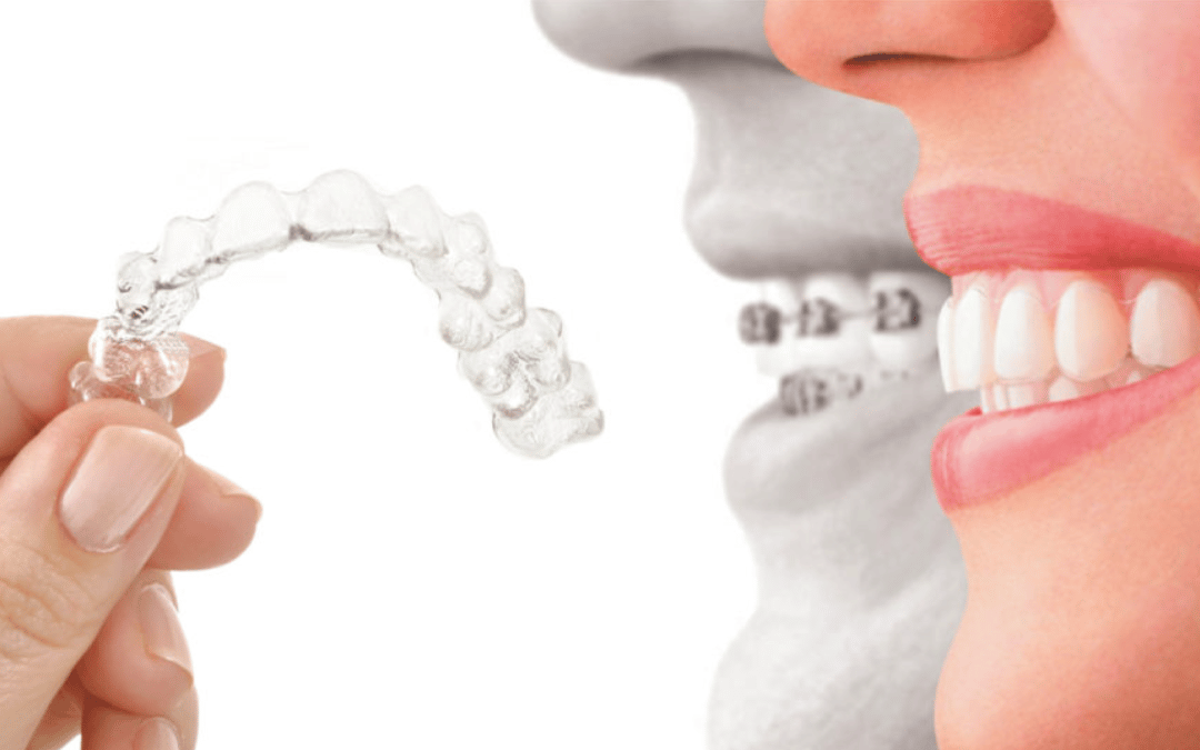 Why Choose Invisalign in Waterloo for a Perfect Smile